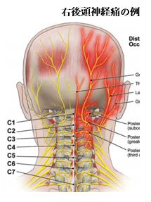 後頭神経痛 だいだいクリニック 九段下頭痛外来 脳神経内科 脳神経外科 内科