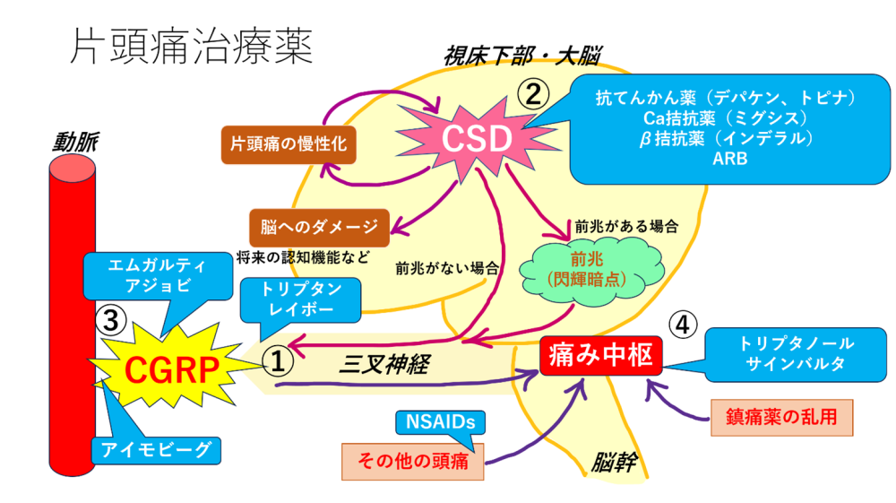 片頭痛治療の概略